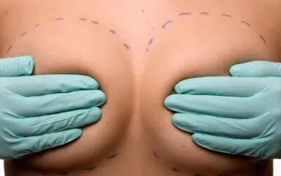 Augmentation mammaire par lipofilling | Drs Kerfant et Trimaille | Brest